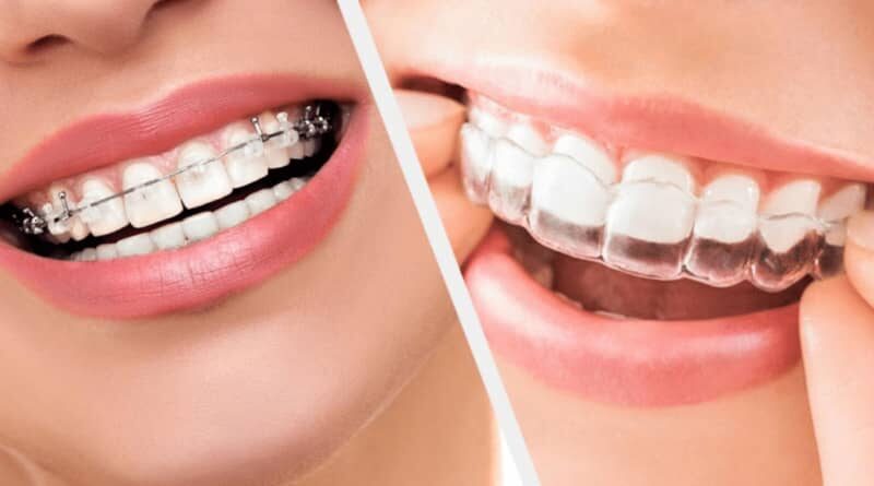 orthodontiste paris adulte