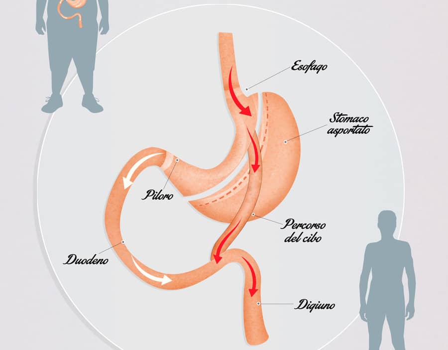 Un schéma décrivant le fonctionnement de l'opération bypass gastrique