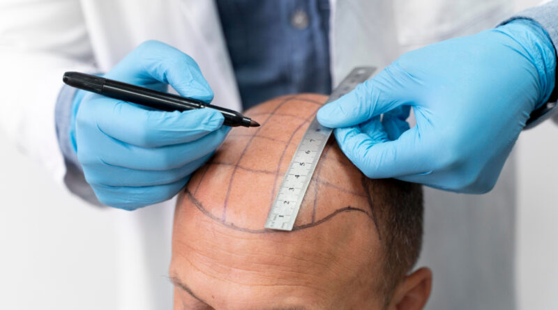 Calvitie : quel médecin spécialiste consulter pour vos cheveux ?